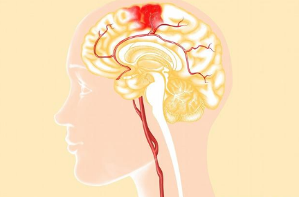 脑出血新型辅助治疗手段—三氧免疫自血疗法